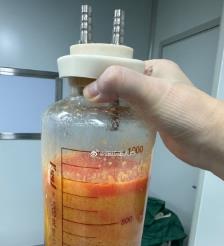 榆林水动力吸脂手术要做多久？